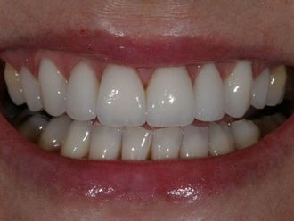 Zahnimplantat - 780967