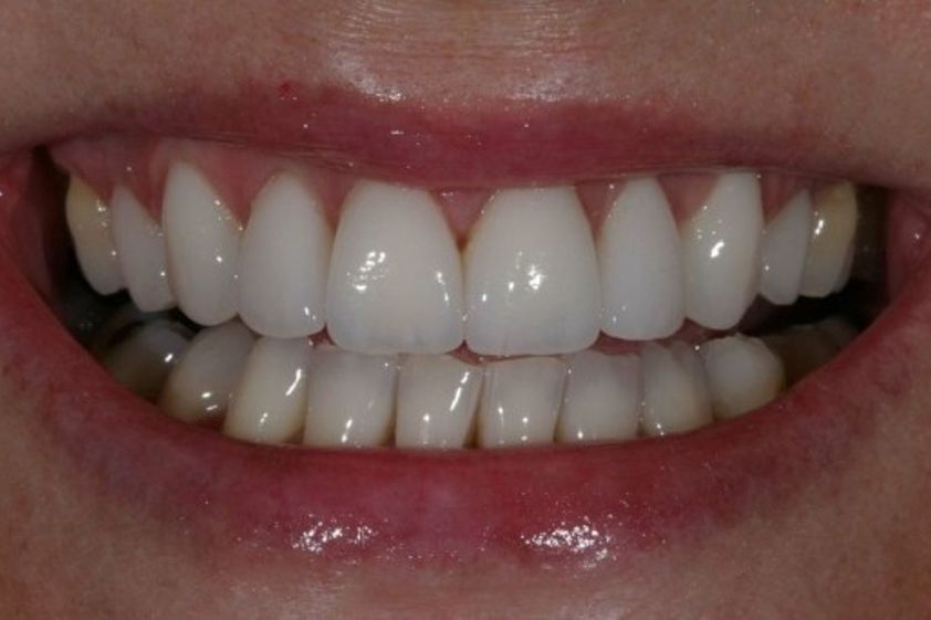 Zahnimplantat resultate - 780967