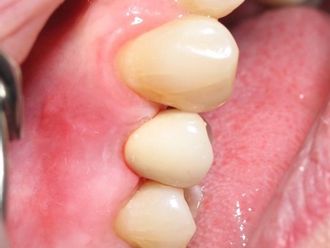 Zahnimplantat - 780969