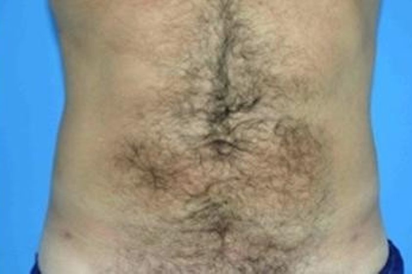 Bodylift resultate - 781730