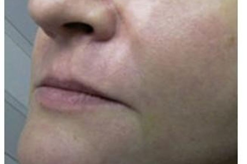 Botox resultate - 781737