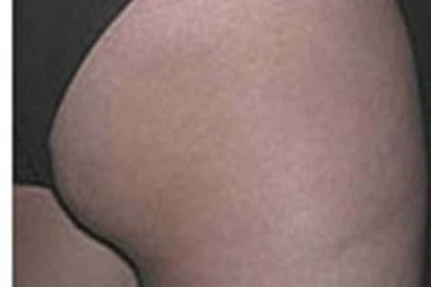 Cellulite resultate - 781738