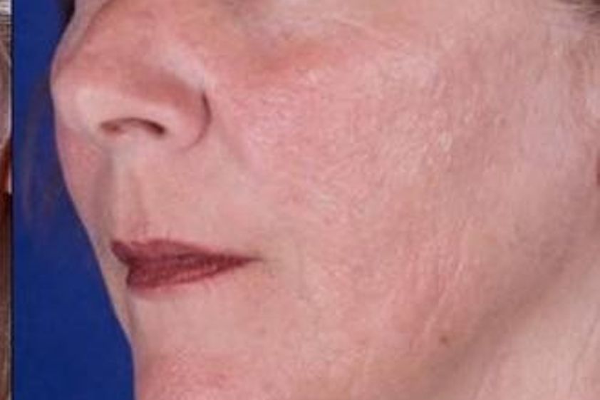Resurfacing resultate - 781747