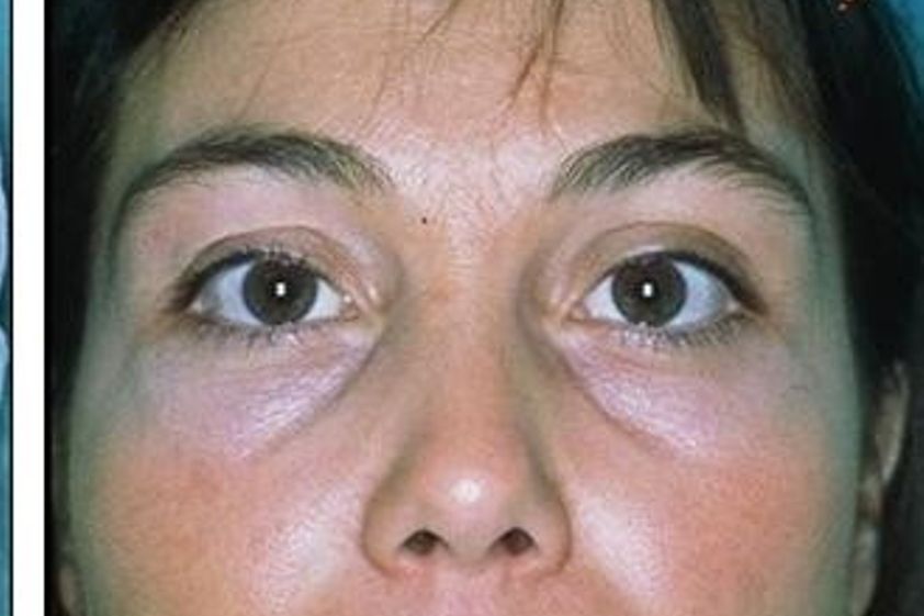 Peeling resultate - 781753