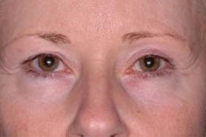 Anti-Aging resultate - 781775