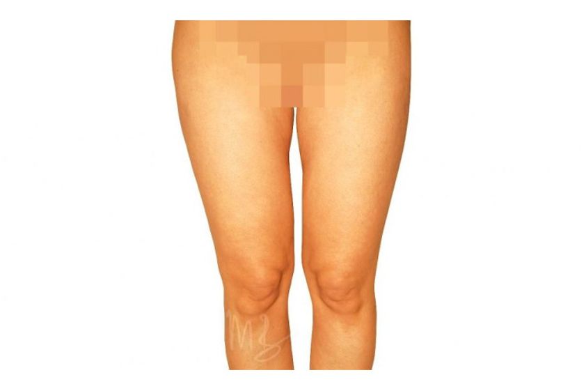 Fettabsaugung resultate - 795207
