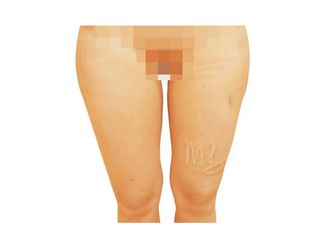 Fettabsaugung resultate - 795210