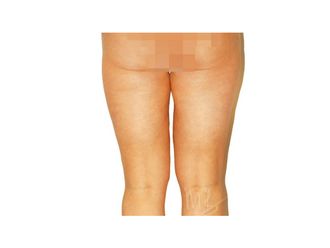 Fettabsaugung resultate - 795211