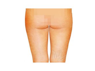 Fettabsaugung resultate - 795212