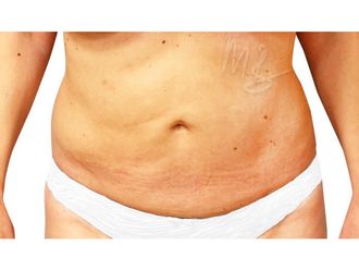 Fettabsaugung resultate - 795214