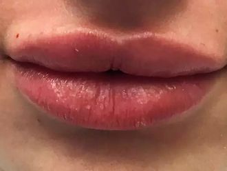 Lippenvergrößerung mit Hyaluronsäure - 784284