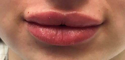 Lippenvergrößerung mit Hyaluronsäure