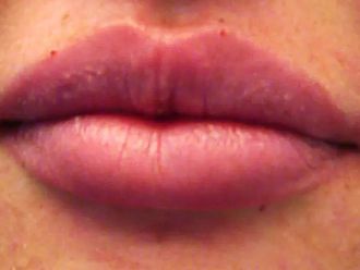 Lippenvergrößerung mit Hyaluronsäure - 784285