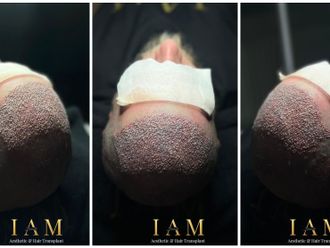 Haartransplantation resultate - 868106