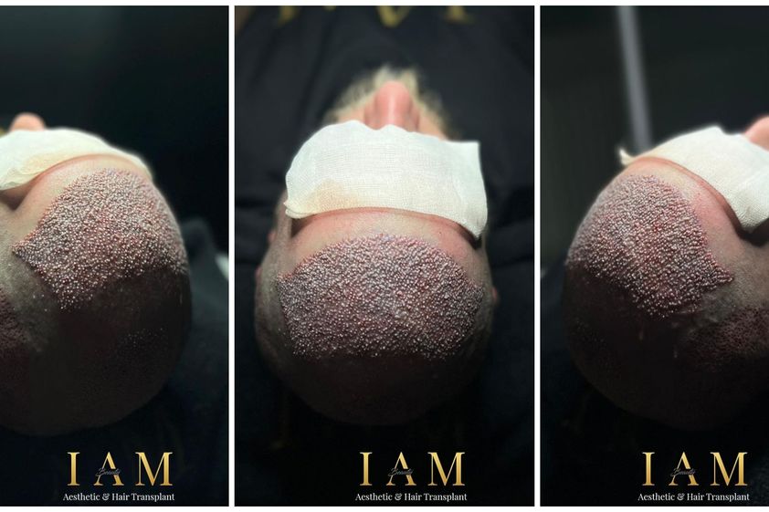 Haartransplantation resultate - 868106