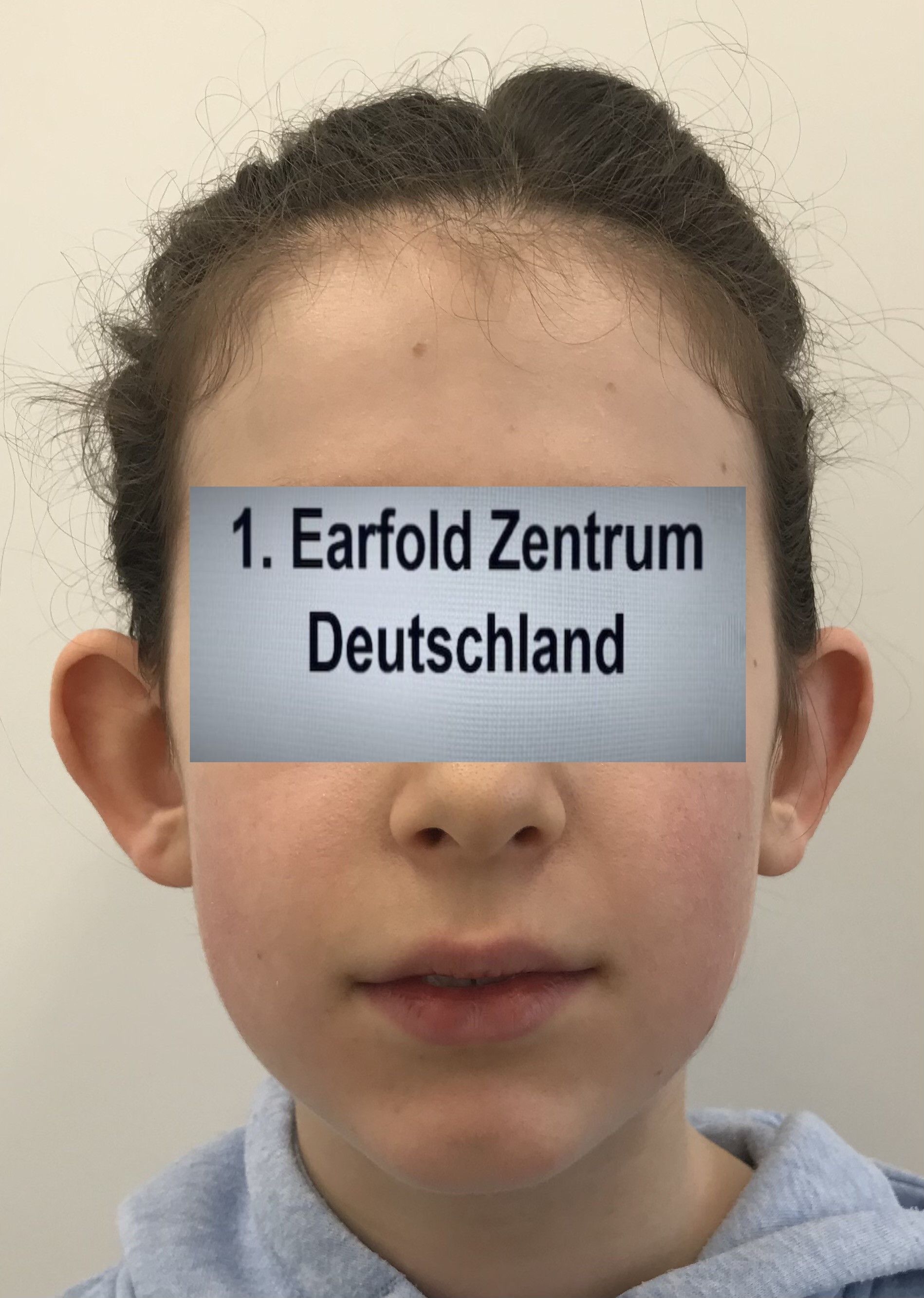 Abstehende Ohren - Earfold beim 8-jährigen Kind SUPER gelungen - Estheticon.de