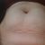 Behandlung von Reiterhosen und Straffung am Bauch