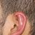Ohrenkorrektur mit Earfold Methode bei Dr. Narwan 