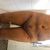 Liposuktion bei Dr. Kupka, Karlsbad 