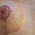 10 Tage nach Bruststraffung mit 325 cc