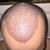 Haartransplantation 4000 Grafts - sehr zufrieden mit dem Resultat