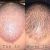 Haartransplantation 4000 Grafts - sehr zufrieden mit dem Resultat