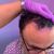 Super Arbeit und klasse Behandlung bei Haartransplantation