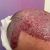 Super Arbeit und klasse Behandlung bei Haartransplantation