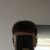 Haartransplantation bei MedicalInn Hair