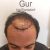 Haartransplantion in Istanbul mit 3080 Grafts