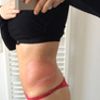 Kryolipolyse an Hüften - gespannt auf Endergebnis