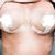 Liposuktion und Bruststraffung mit Implantat, 315ml, von 75C zu 75D: tolles Ergebnis