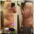 Bodylift mit Entfernung von 2,5 kg Haut: ganz okay