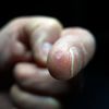 Entfernung einer Warze am Finger