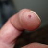 Entfernung einer Warze am Finger