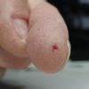 Entfernung einer Warze am Finger