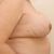 Herausnahme eines Implantats