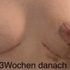 Bruststraffung Tubuläre Brust, tolles Ergebnis!