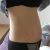 Bauchdeckenstraffung mit Lipo nach Schwangerschaft - top Ergebnis