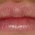 Natürliche Lippenvergrößerung bei Frau Dr. Hreus