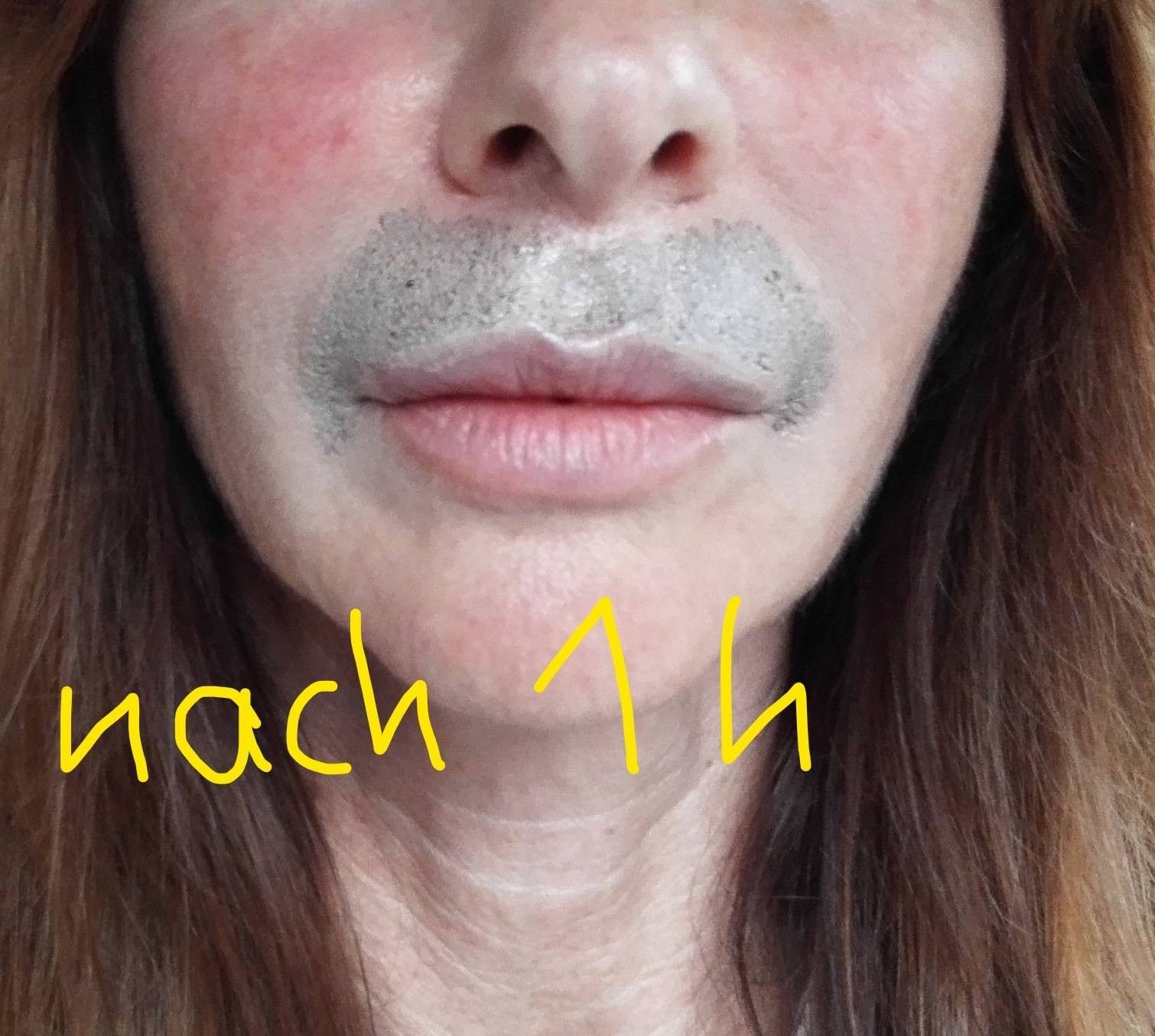 PlexRBehandlung für Plisseefältchen über der Oberlippe Estheticon.de