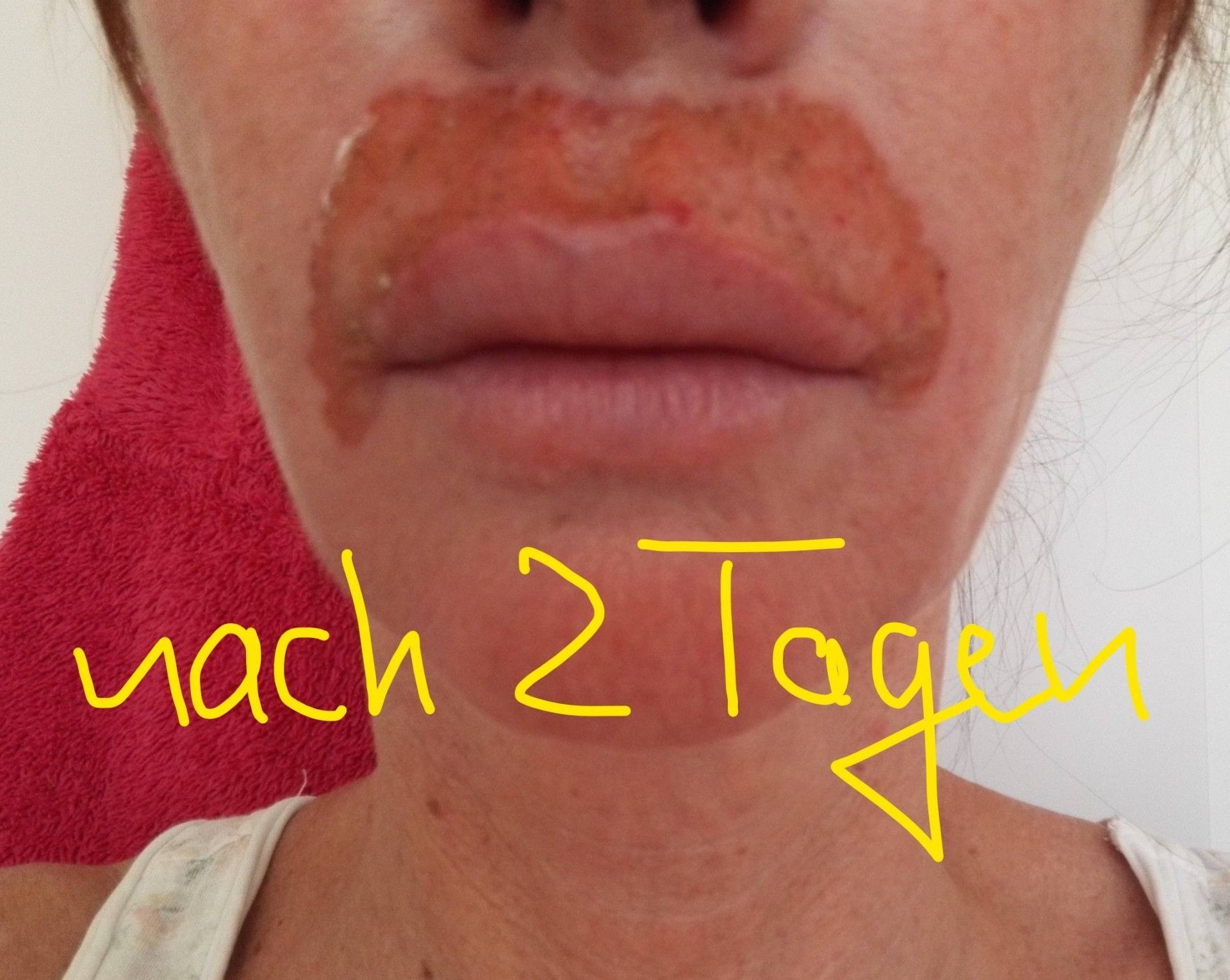PlexRBehandlung für Plisseefältchen über der Oberlippe Estheticon.de