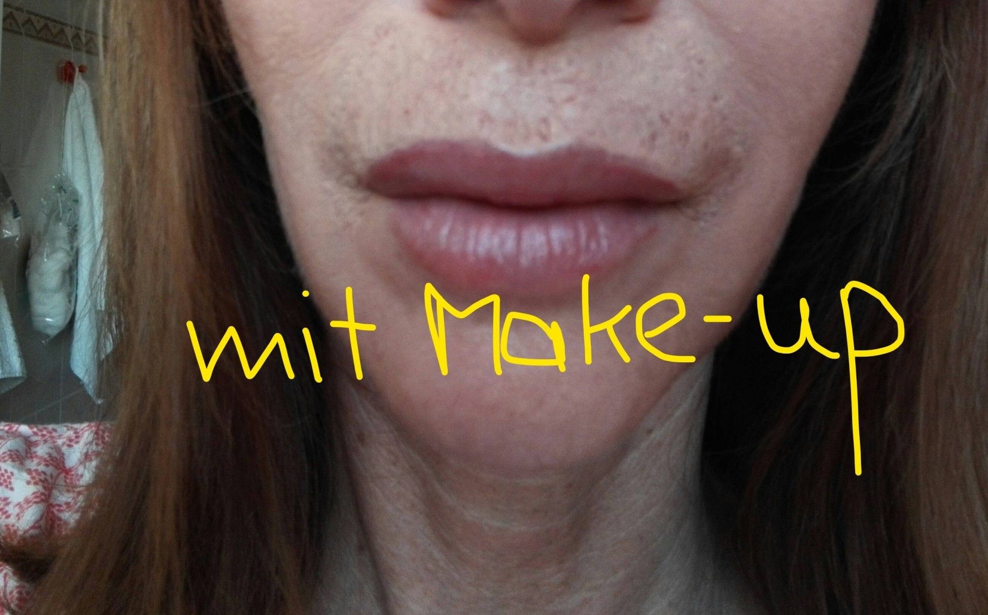 PlexRBehandlung für Plisseefältchen über der Oberlippe Estheticon.de