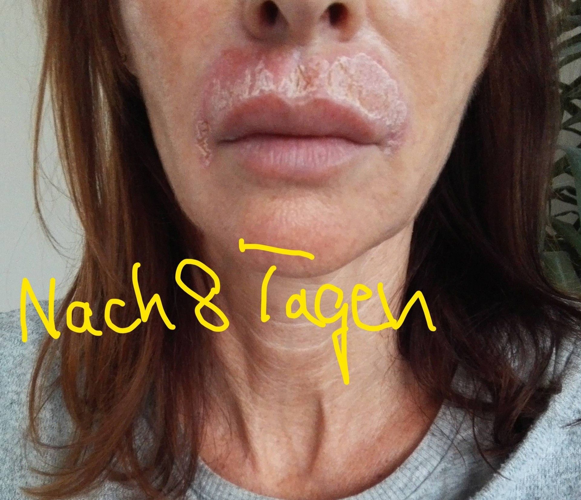 PlexRBehandlung für Plisseefältchen über der Oberlippe Estheticon.de