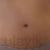 Liposuktion by a really competent and professional Doctor!!!!
