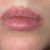 Wunderschönes Direktes Lippenlift