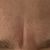 Kombi Behandlung Botox, Skinbooster und Laser - in Hannover