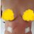 Miniabdominoplastik mit Liposuktion: Investition für neues Selbstwertgefühl