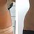 Schonende Kryolipolyse an Bauch und Hüften