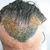 FUE - Haartransplantation mit Teilrasur: 3.264 Grafts 